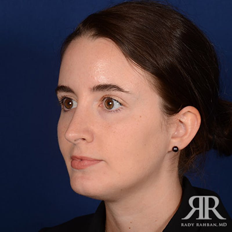 Rhinoplasty w/ Chin Implant Before & After Gallery - Patient 350329 - Image 4