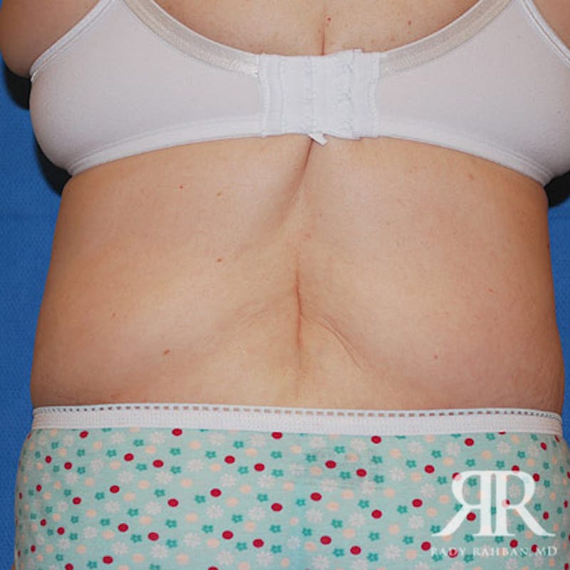 Body Lift Before & After Gallery - Patient 498644 - Image 6