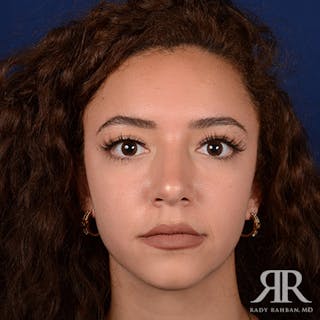 Female Rhinoplasty Before & After Gallery - Patient 173091 - Image 2