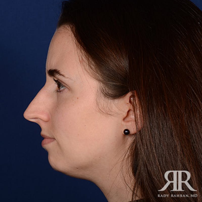 Rhinoplasty w/ Chin Implant Before & After Gallery - Patient 350329 - Image 5