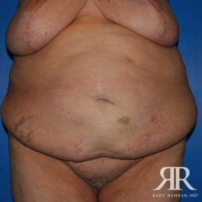 Body Lift Before & After Gallery - Patient 318154 - Image 1