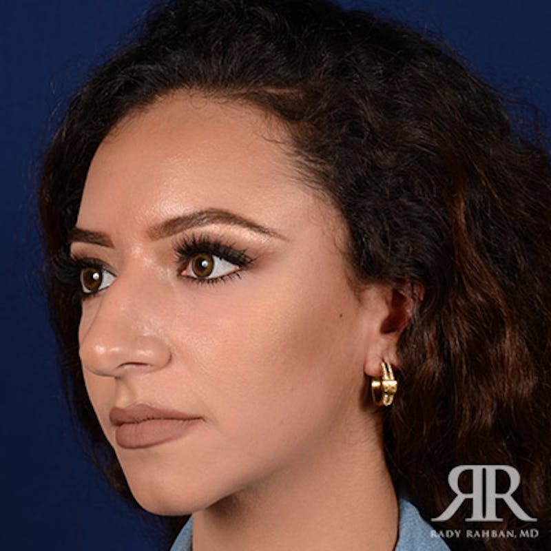 Female Rhinoplasty Before & After Gallery - Patient 173091 - Image 3