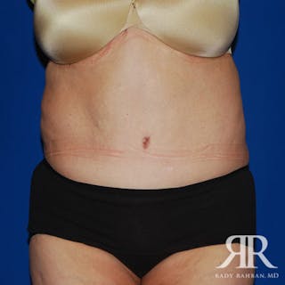 Body Lift Before & After Gallery - Patient 318154 - Image 2