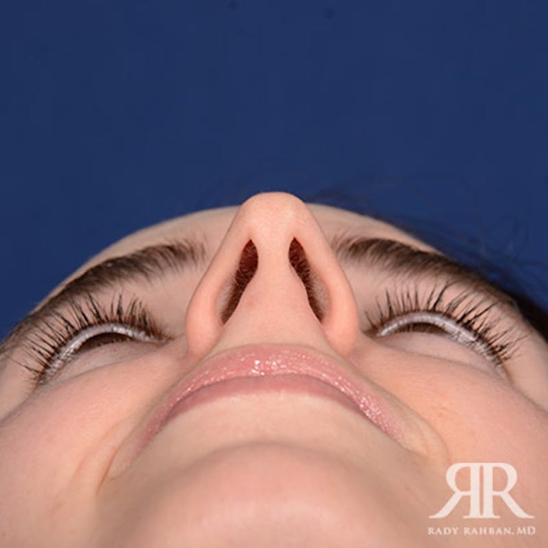 Rhinoplasty w/ Chin Implant Before & After Gallery - Patient 350329 - Image 7