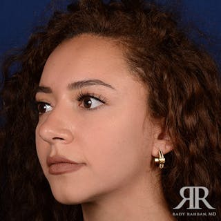 Female Rhinoplasty Before & After Gallery - Patient 173091 - Image 4