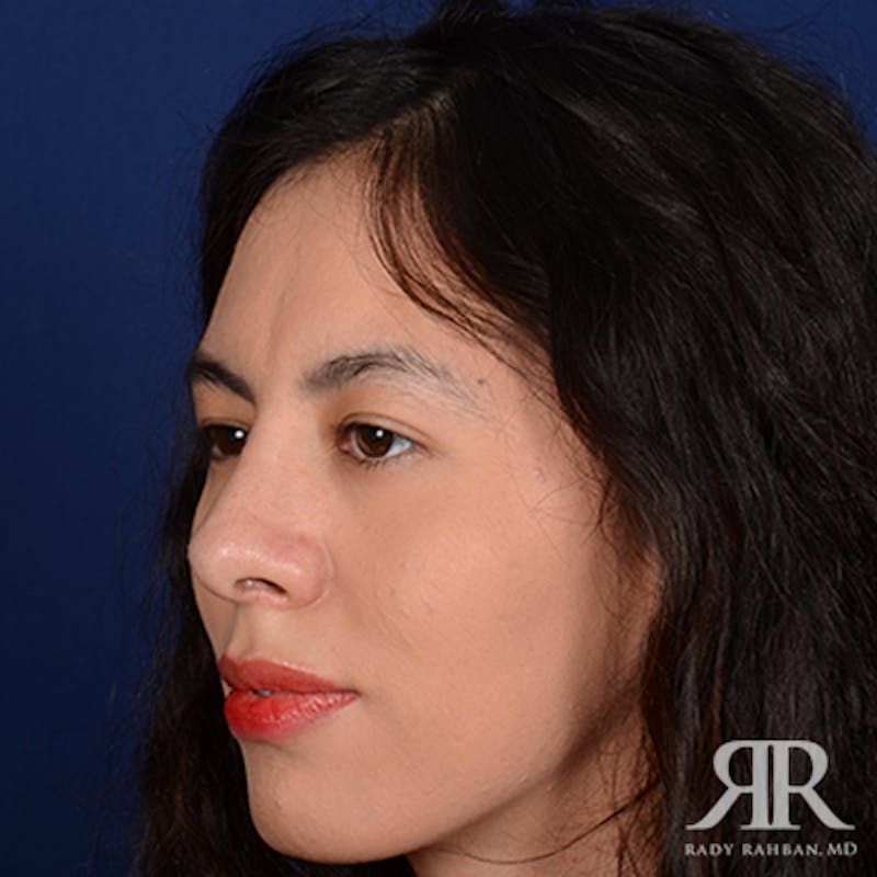 Ethnic Rhinoplasty Before & After Gallery - Patient 224997 - Image 4