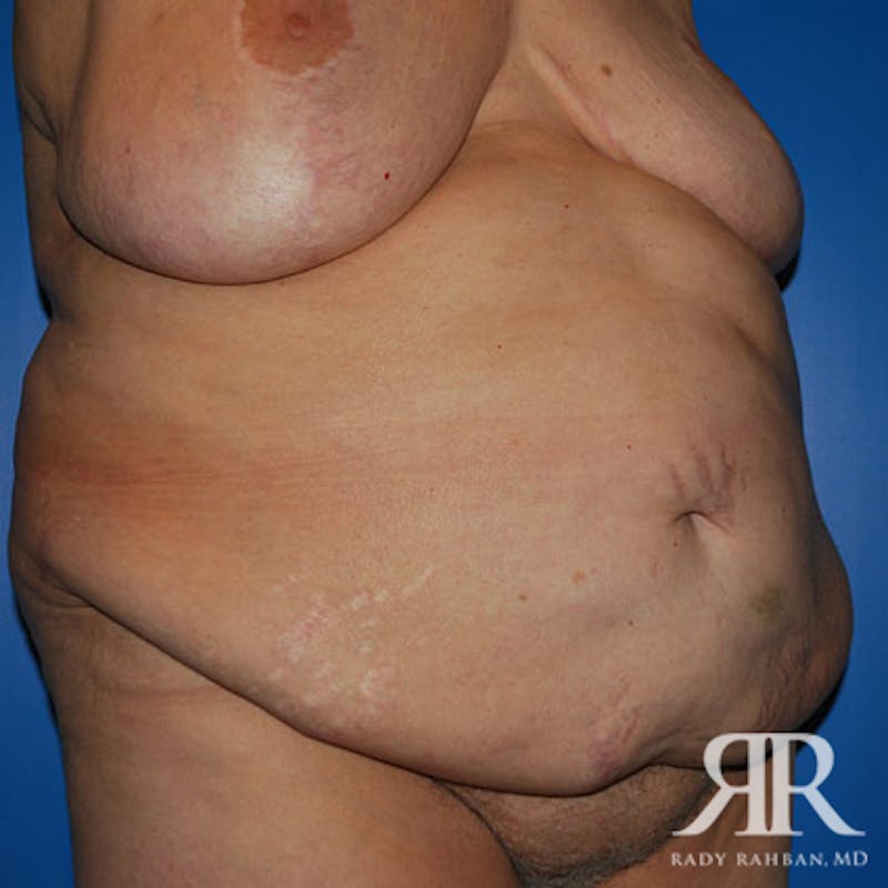Body Lift Before & After Gallery - Patient 318154 - Image 3