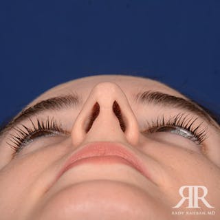 Rhinoplasty w/ Chin Implant Before & After Gallery - Patient 350329 - Image 8