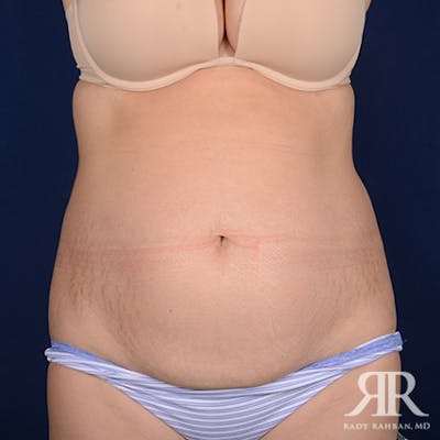Severe Diastasis Recti Before & After Gallery - Patient 352157 - Image 1