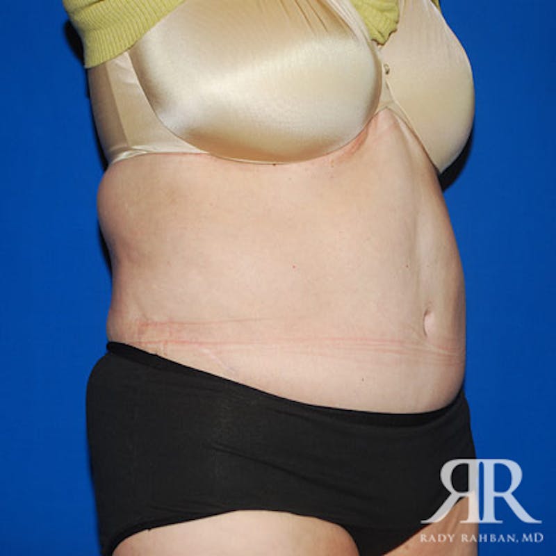 Body Lift Before & After Gallery - Patient 318154 - Image 4