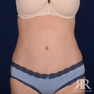 Severe Diastasis Recti Before & After Gallery - Patient 352157 - Image 2