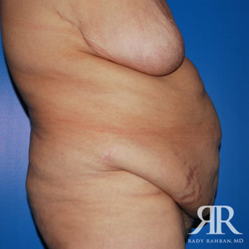Body Lift Before & After Gallery - Patient 318154 - Image 5