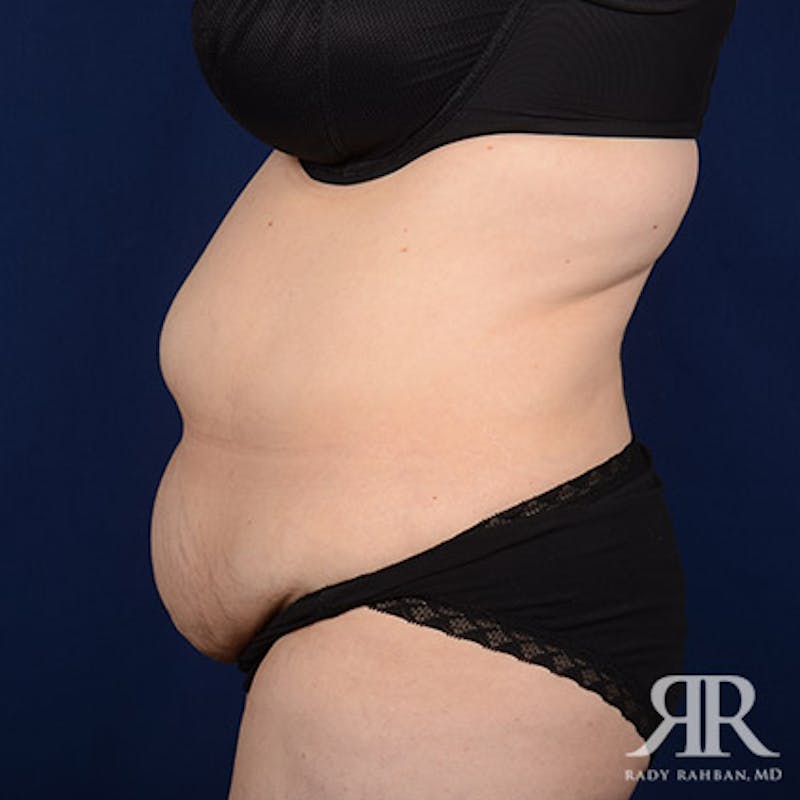 Tummy Tuck Before & After Gallery - Patient 407313 - Image 5