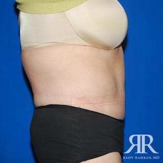 Body Lift Before & After Gallery - Patient 318154 - Image 6
