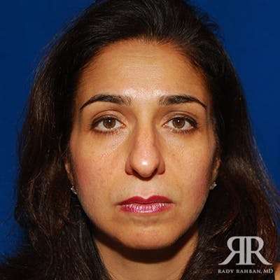 Ethnic Rhinoplasty Before & After Gallery - Patient 389186 - Image 1
