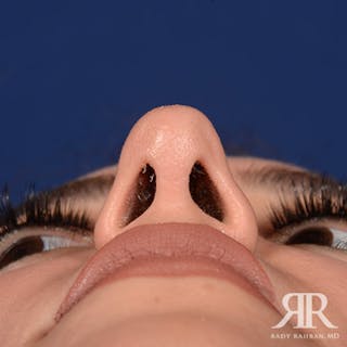 Female Rhinoplasty Before & After Gallery - Patient 173091 - Image 8
