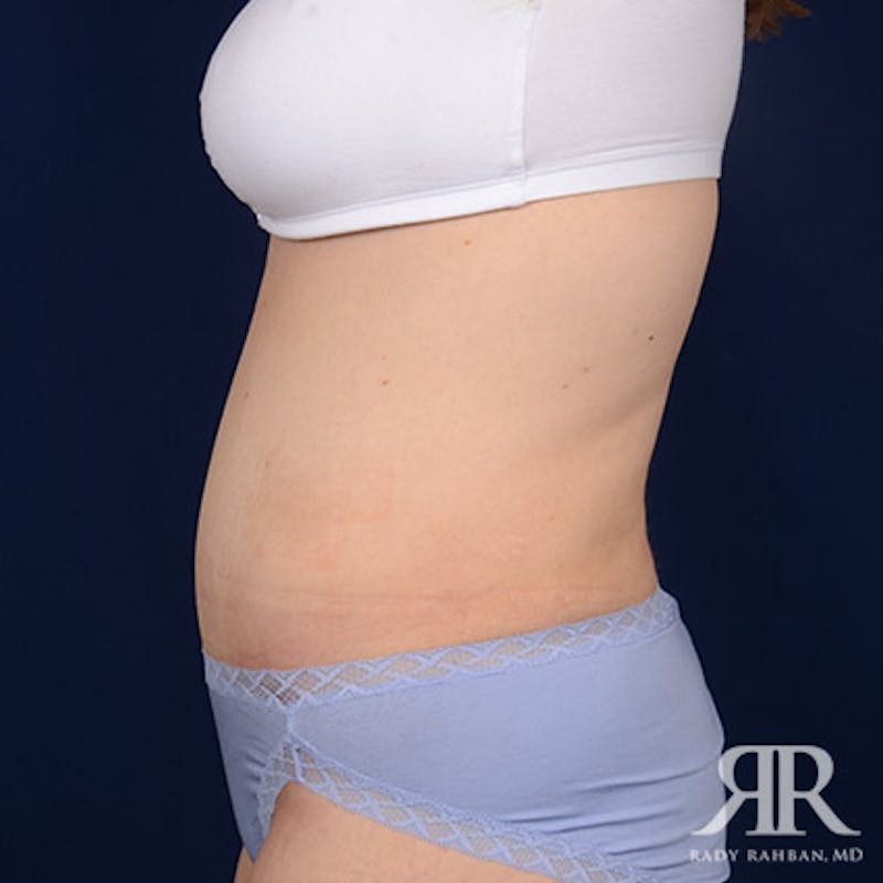 Tummy Tuck Before & After Gallery - Patient 407313 - Image 6
