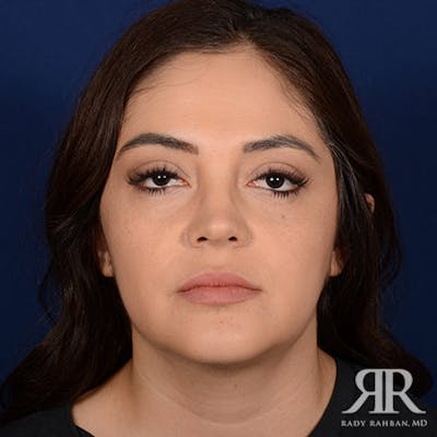 Chin Augmentation Before & After Gallery - Patient 328182 - Image 2