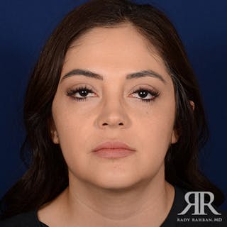 Chin Augmentation Before & After Gallery - Patient 328182 - Image 2