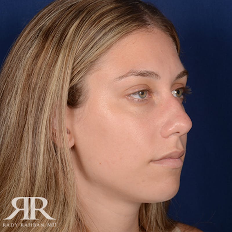 Rhinoplasty w/ Chin Implant Before & After Gallery - Patient 158699 - Image 3