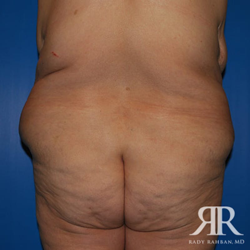 Body Lift Before & After Gallery - Patient 318154 - Image 7