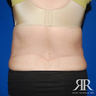 Body Lift Before & After Gallery - Patient 318154 - Image 8
