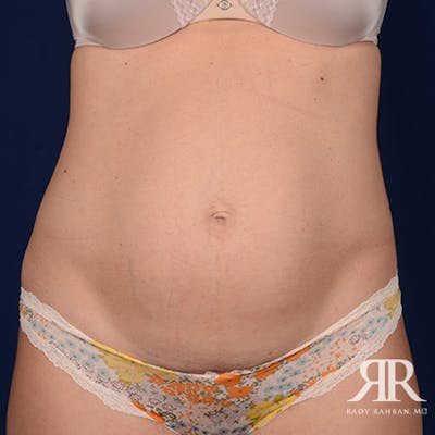 Tummy Tuck Before & After Gallery - Patient 338731 - Image 1