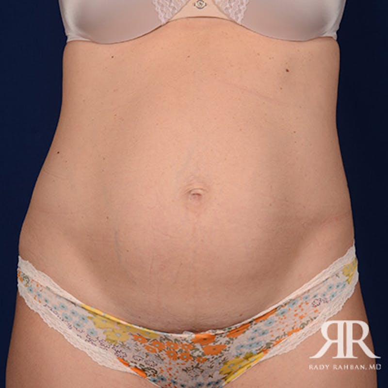 Tummy Tuck Before & After Gallery - Patient 338731 - Image 1