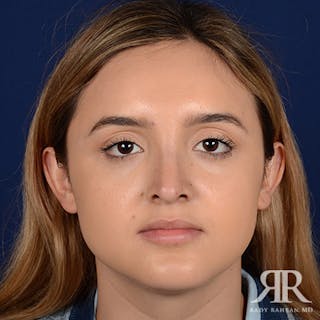 Female Rhinoplasty Before & After Gallery - Patient 756757 - Image 2