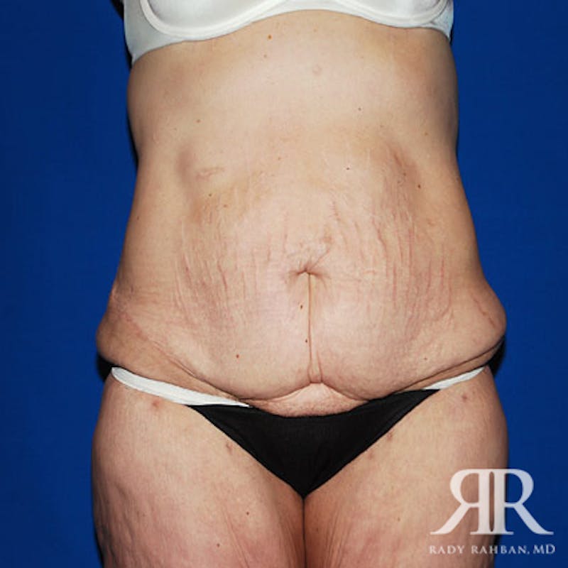 Body Lift Before & After Gallery - Patient 383870 - Image 1