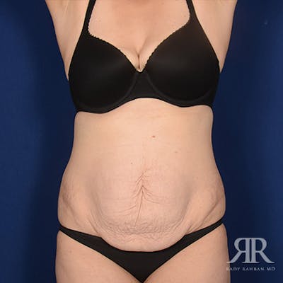 Severe Diastasis Recti Before & After Gallery - Patient 416055 - Image 1