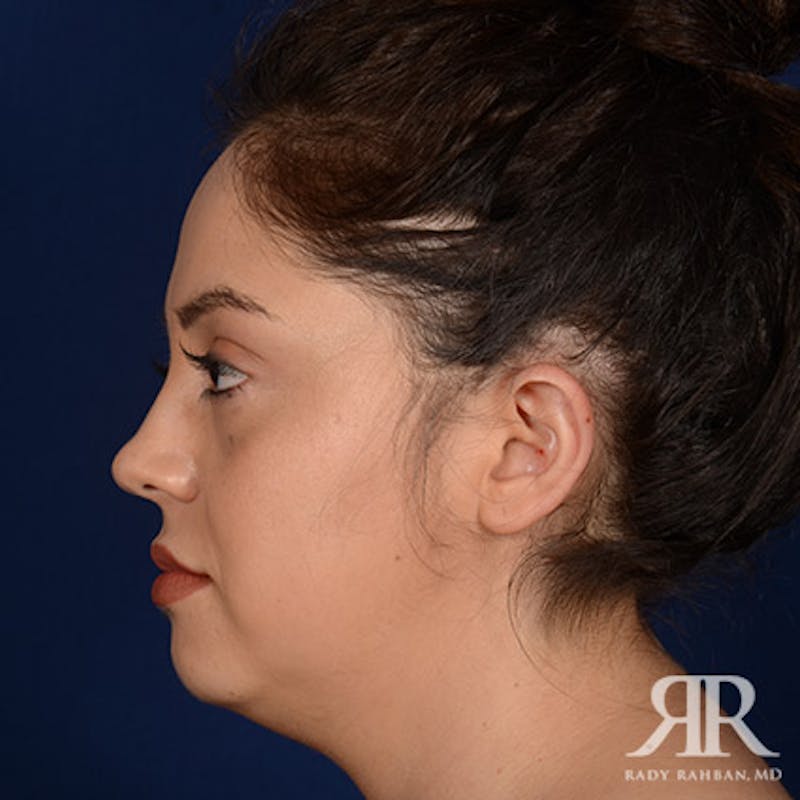 Chin Augmentation Before & After Gallery - Patient 328182 - Image 5
