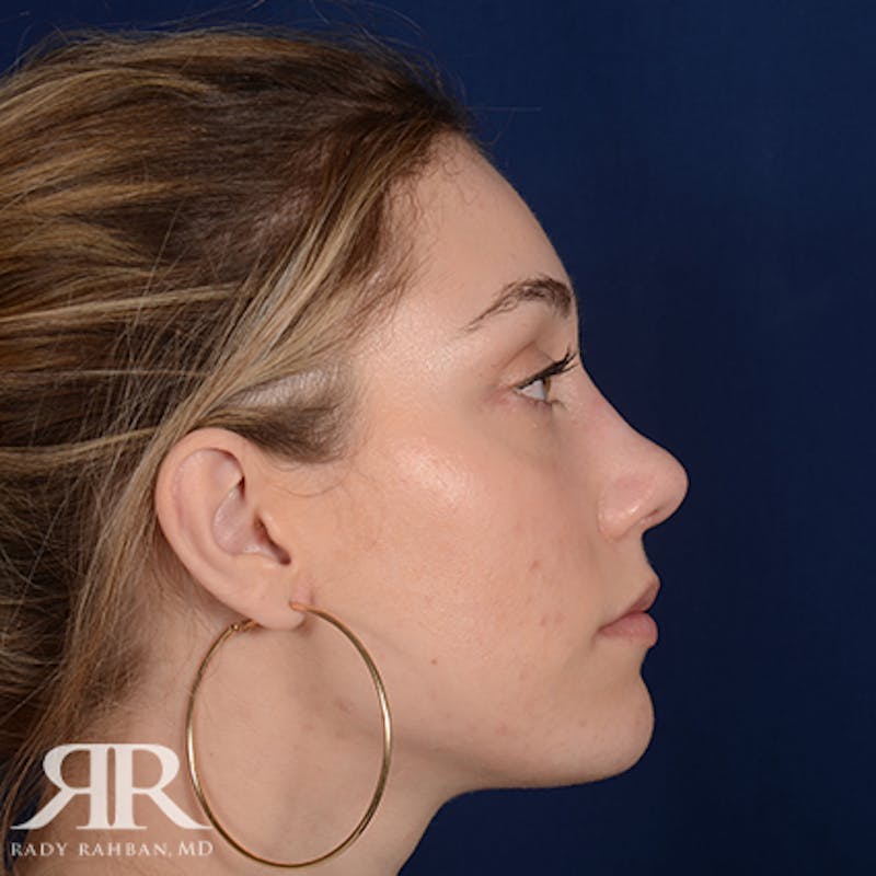 Rhinoplasty w/ Chin Implant Before & After Gallery - Patient 158699 - Image 6
