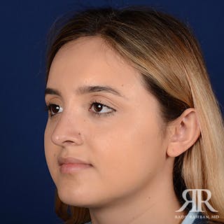 Female Rhinoplasty Before & After Gallery - Patient 756757 - Image 4