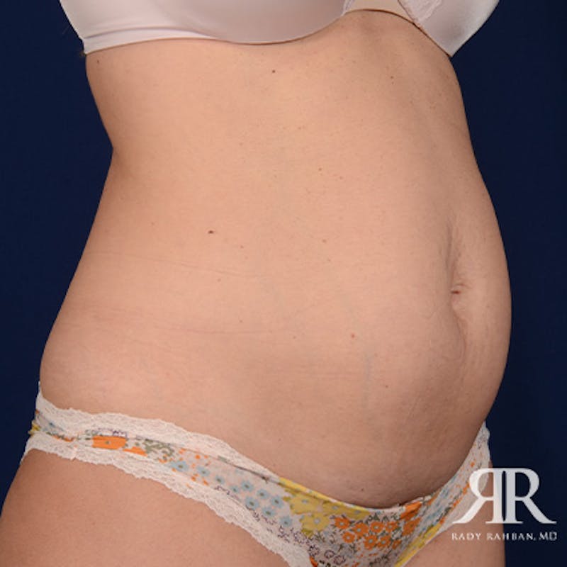 Tummy Tuck Before & After Gallery - Patient 338731 - Image 3