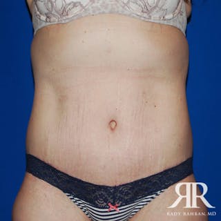 Body Lift Before & After Gallery - Patient 383870 - Image 2