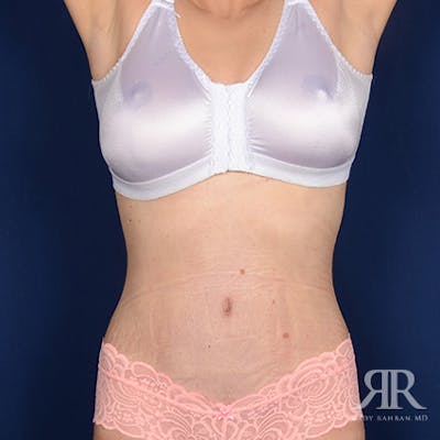 Severe Diastasis Recti Before & After Gallery - Patient 416055 - Image 2