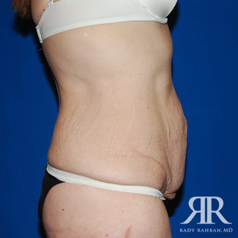 Body Lift Before & After Gallery - Patient 383870 - Image 3