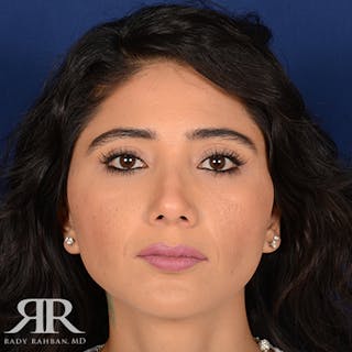 Rhinoplasty w/ Chin Implant Before & After Gallery - Patient 126559 - Image 2