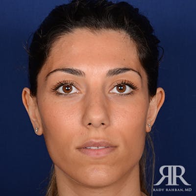 Ethnic Rhinoplasty Before & After Gallery - Patient 238809 - Image 1