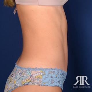 Tummy Tuck Before & After Gallery - Patient 338731 - Image 6