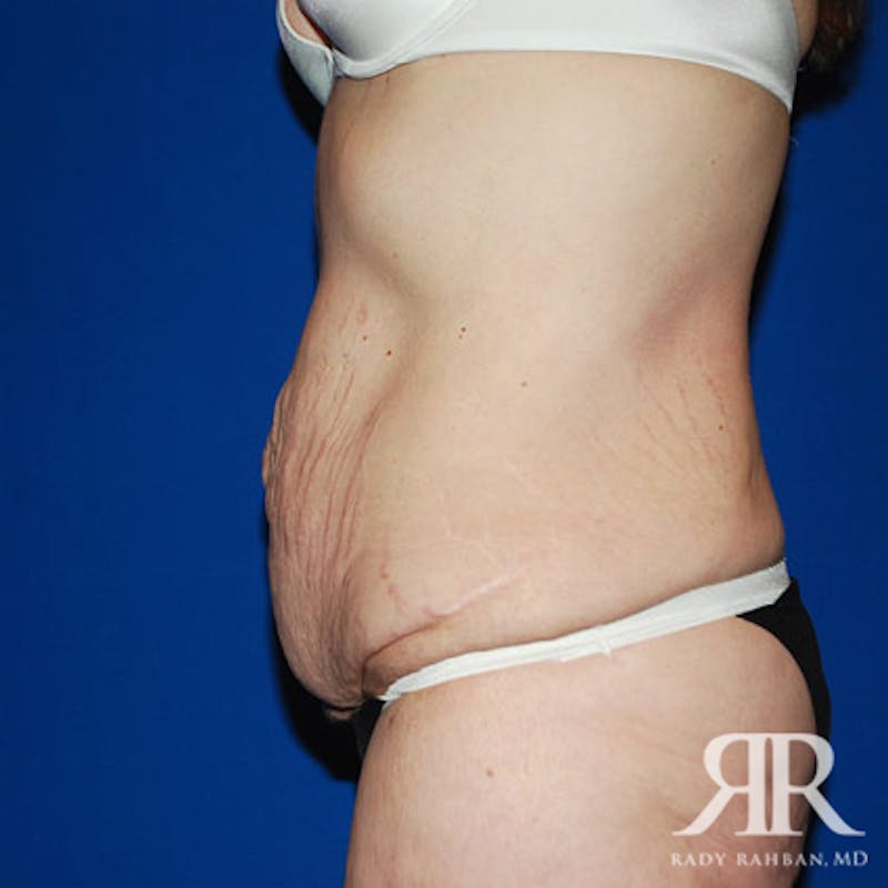 Body Lift Before & After Gallery - Patient 383870 - Image 5