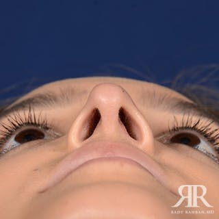 Female Rhinoplasty Before & After Gallery - Patient 756757 - Image 8