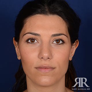 Ethnic Rhinoplasty Before & After Gallery - Patient 238809 - Image 2