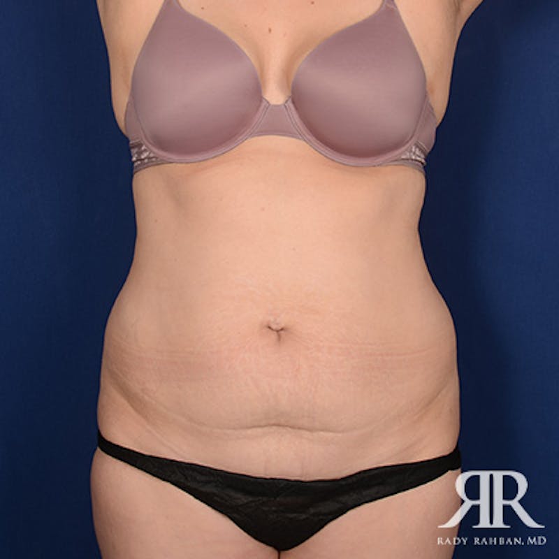 Tummy Tuck Before & After Gallery - Patient 355839 - Image 1
