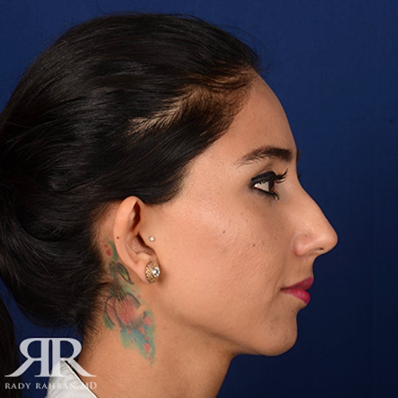 Rhinoplasty w/ Chin Implant Before & After Gallery - Patient 126559 - Image 5