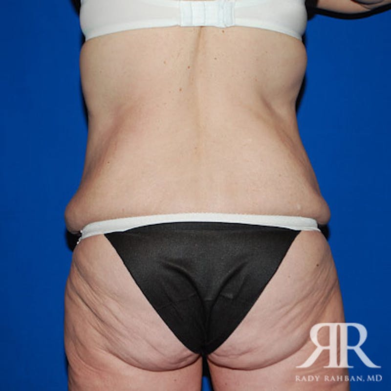 Body Lift Before & After Gallery - Patient 383870 - Image 7