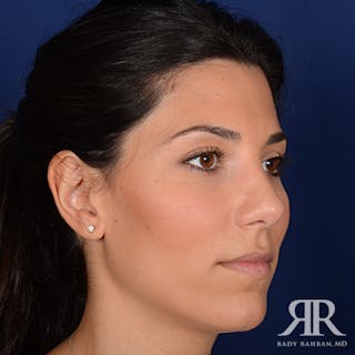 Ethnic Rhinoplasty Before & After Gallery - Patient 238809 - Image 4