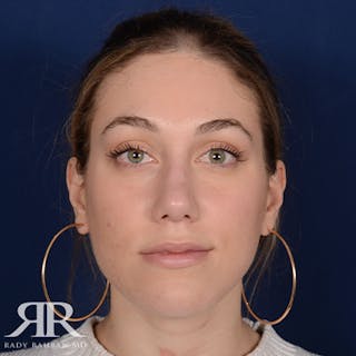 Female Rhinoplasty Before & After Gallery - Patient 116036 - Image 2