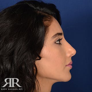 Rhinoplasty w/ Chin Implant Before & After Gallery - Patient 126559 - Image 6